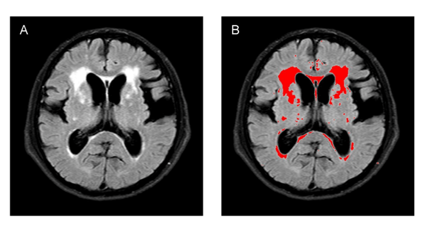 Quantitative-analysis-of-white-matter-hyperintensity-volume-A-representative